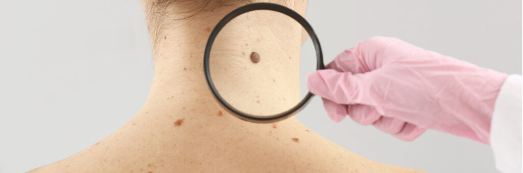 What Are the Beginning Signs of Melanoma? - Welcome to Dermatology ...